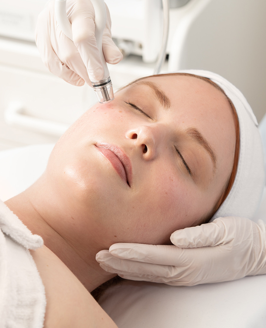 microneedling treatment performed on womans cheek