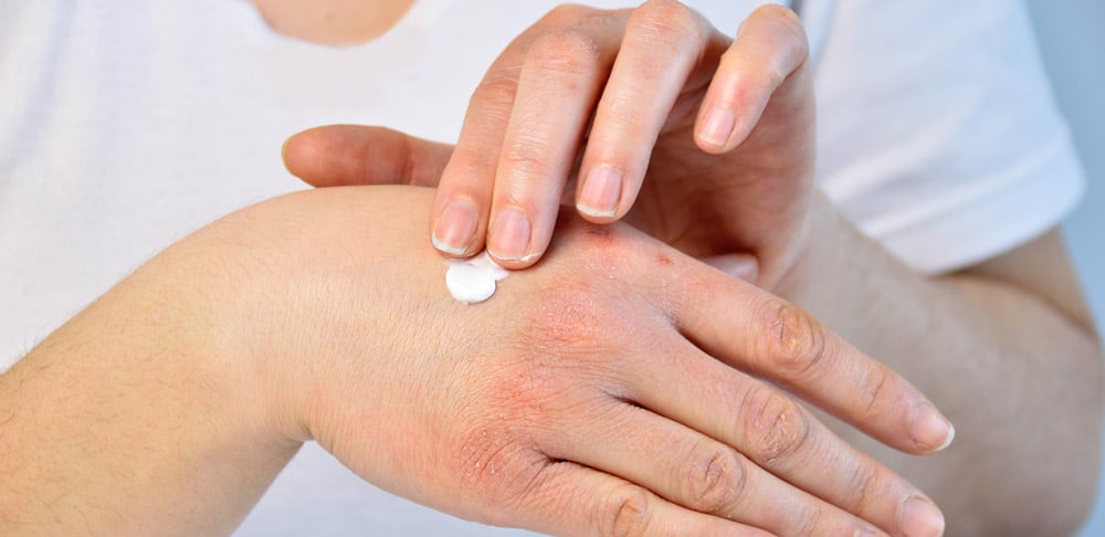 person adding lotion to hands due to dry skin