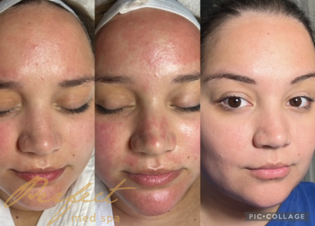  PRP Microneedling Before and After Photo by Perfect Med Spa in New York, NY 